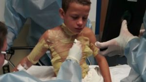 12 year old suffers second degree burns while attempting fire challenge