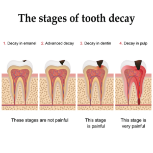 tooth decay stages in dental care